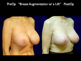 Aug-Lift.002.jpg