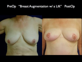 Aug-Lift.008.jpg