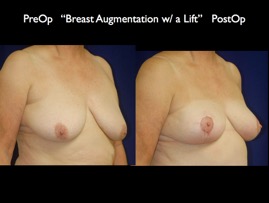 Aug-Lift.009.jpg