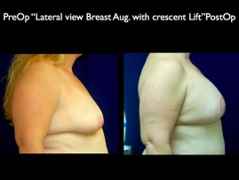 Breast-Aug.006.jpg