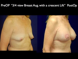 Breast-Aug.008.jpg