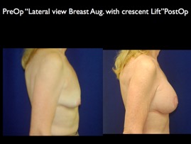 Breast-Aug.009.jpg