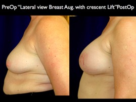 Breast-Aug.012.jpg