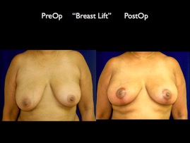 BreastLift.001.jpg