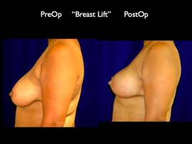 BreastLift.003.jpg