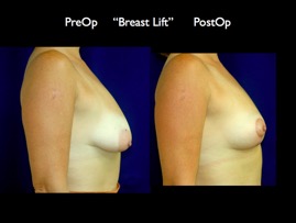 BreastLift.006.jpg