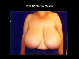 BreastReduc2.002.jpg