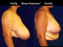 BreastReduc2.003.jpg