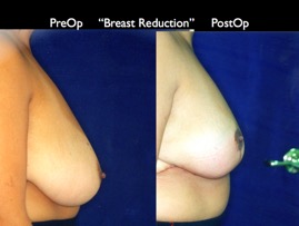 BreastReduc2.006.jpg