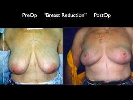 BreastReduc2.007.jpg