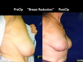 BreastReduc2.008.jpg