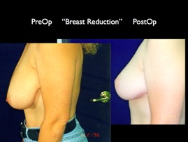 BreastReduc2.012.jpg