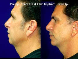 FacLift.016.jpg