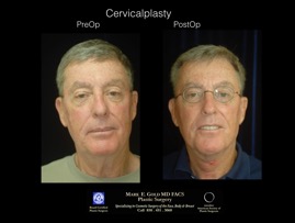 CervicalPlasty.001.jpg