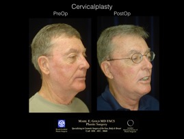 CervicalPlasty.002.jpg