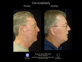 CervicalPlasty.003.jpg