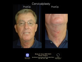 CervicalPlasty.004.jpg