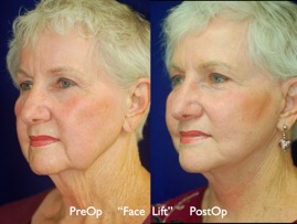 FacLift.021.jpg