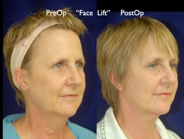 FacLift.024.jpg