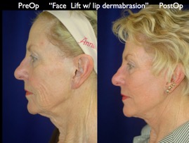 FacLift.031.jpg