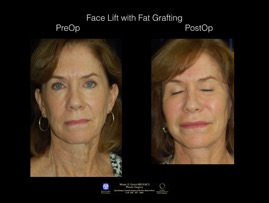 FaceLift-Fat.1.jpg
