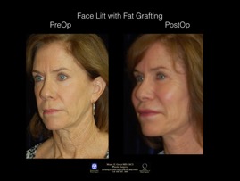 FaceLift-Fat.4.jpg
