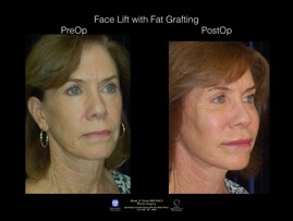 FaceLift-Fat.2.jpg