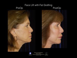 FaceLift-Fat.3.jpg