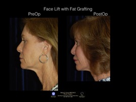 FaceLift-Fat.5.jpg