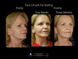 FaceLift-Fat.9.jpg