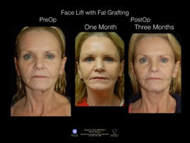 FaceLift-Fat.6.jpg