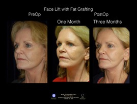 FaceLift-Fat.10.jpg