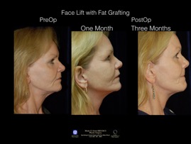 FaceLift-Fat.7.jpg