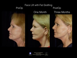 FaceLift-Fat.8.jpg