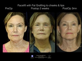 FacLft-Fat.001.jpeg