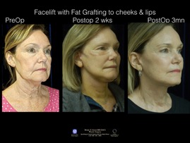 FacLft-Fat.002.jpeg