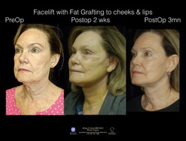 FacLft-Fat.003.jpeg