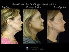 FacLft-Fat.004.jpeg