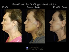 FacLft-Fat.005.jpeg