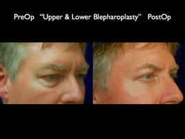Eyelids.009.jpg