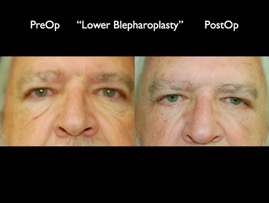 Eyelids.001.jpg