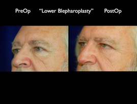 Eyelids.002.jpg