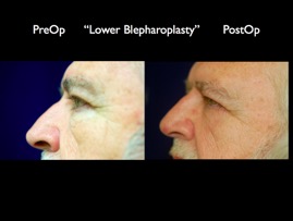 Eyelids.003.jpg