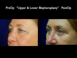 Eyelids.005.jpg