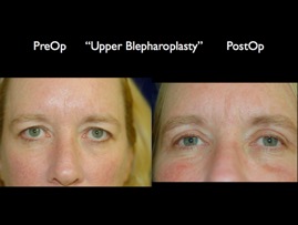 Eyelids.013.jpg