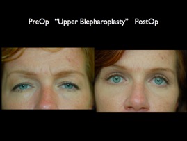 Eyelids.019.jpg