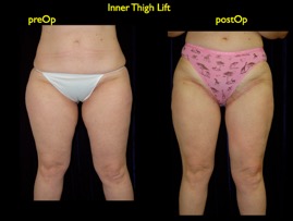 inner thigh.001.jpg
