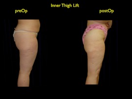 inner thigh.002.jpg