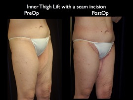 InnerThigh.020.jpg