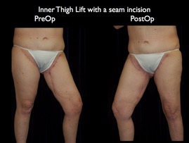InnerThigh.022.jpg